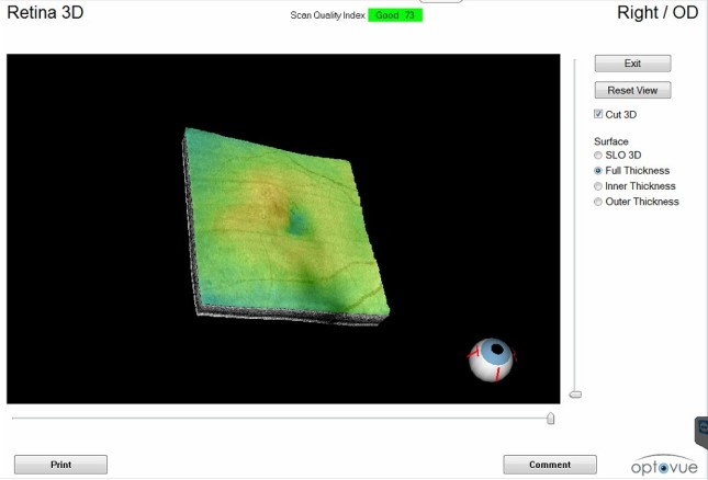 3D image of diabetic retinopathy involving macula