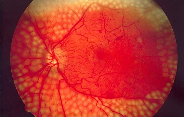 Laser burns on peripheral retina (pic Courtest: http://www.nei.nih.gov/photo/keyword.asp?conditions=Diabetic)