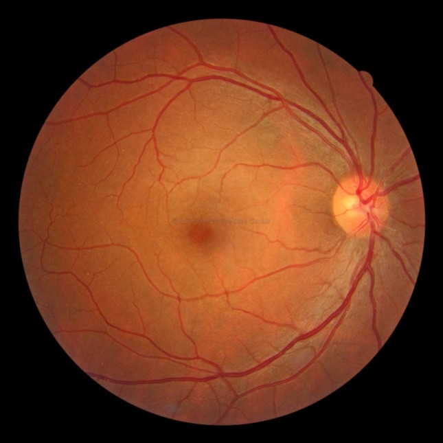 Normal Retina & Macula