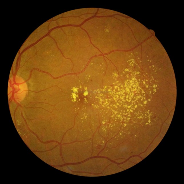 NPDR with maculopathy